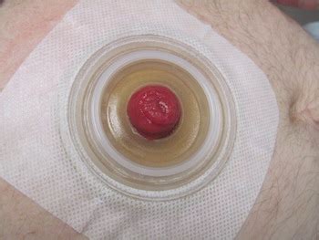 stool leaking around stoma|Stoma Bleeding and Irritation 